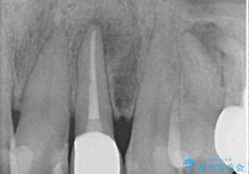 根元がうずく前歯 根管治療とオールセラミック治療の治療後