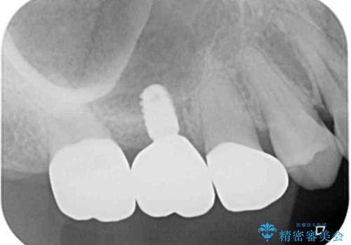 壊れやすいブリッジ インプラント治療で安定した咬み合わせにの治療後