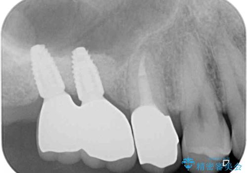 奥歯の欠損部　インプラント補綴治療の治療後