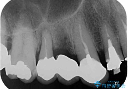 破折した歯 オールセラミックブリッジの補綴治療の治療後