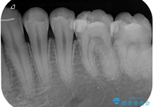 奥歯がしみる 保険の詰め物をセラミックインレーにの治療前