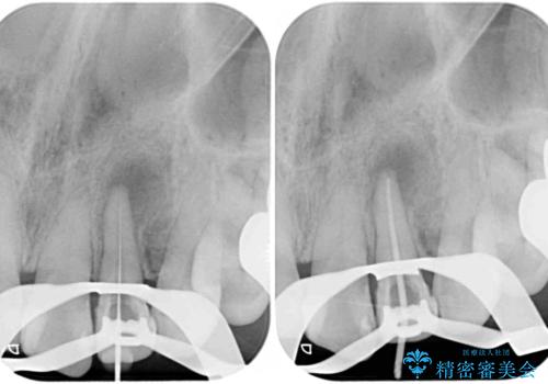 根元がうずく前歯 根管治療とオールセラミック治療の治療中