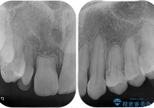 矮小歯と欠損によるずれた位置の大きな歯 オールセラミッククラウンで自然にの治療前