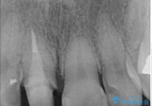 折れてしまった前歯   オールセラミックによる審美改善の治療中