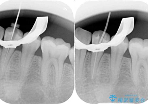 痛みでうずく 根管治療と補綴治療の治療中
