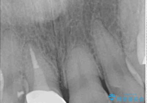 折れてしまった前歯   オールセラミックによる審美改善の治療後