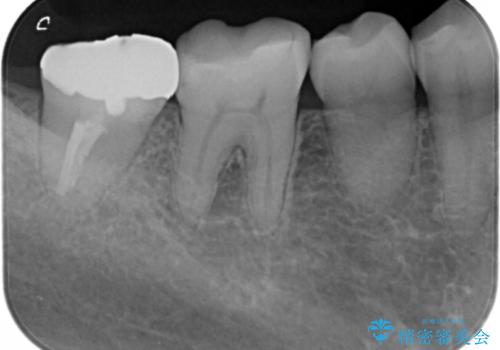奥歯の高さがない　歯周外科で解決の治療前