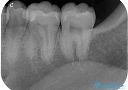 奥歯がしみる 保険の詰め物をセラミックインレーにの治療後