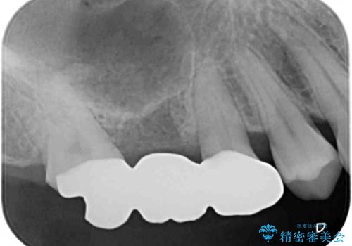 壊れやすいブリッジ インプラント治療で安定した咬み合わせにの治療前