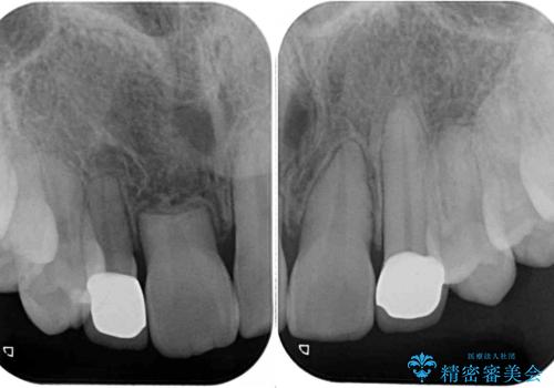 矮小歯と欠損によるずれた位置の大きな歯 オールセラミッククラウンで自然にの治療後