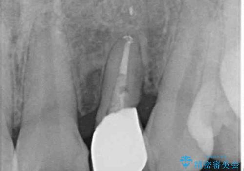 抜歯と言われた前歯 牽引してセラミッククラウンで保存するの治療後