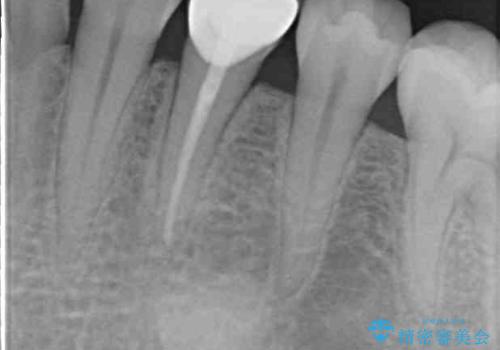 痛みでうずく 根管治療と補綴治療の治療後