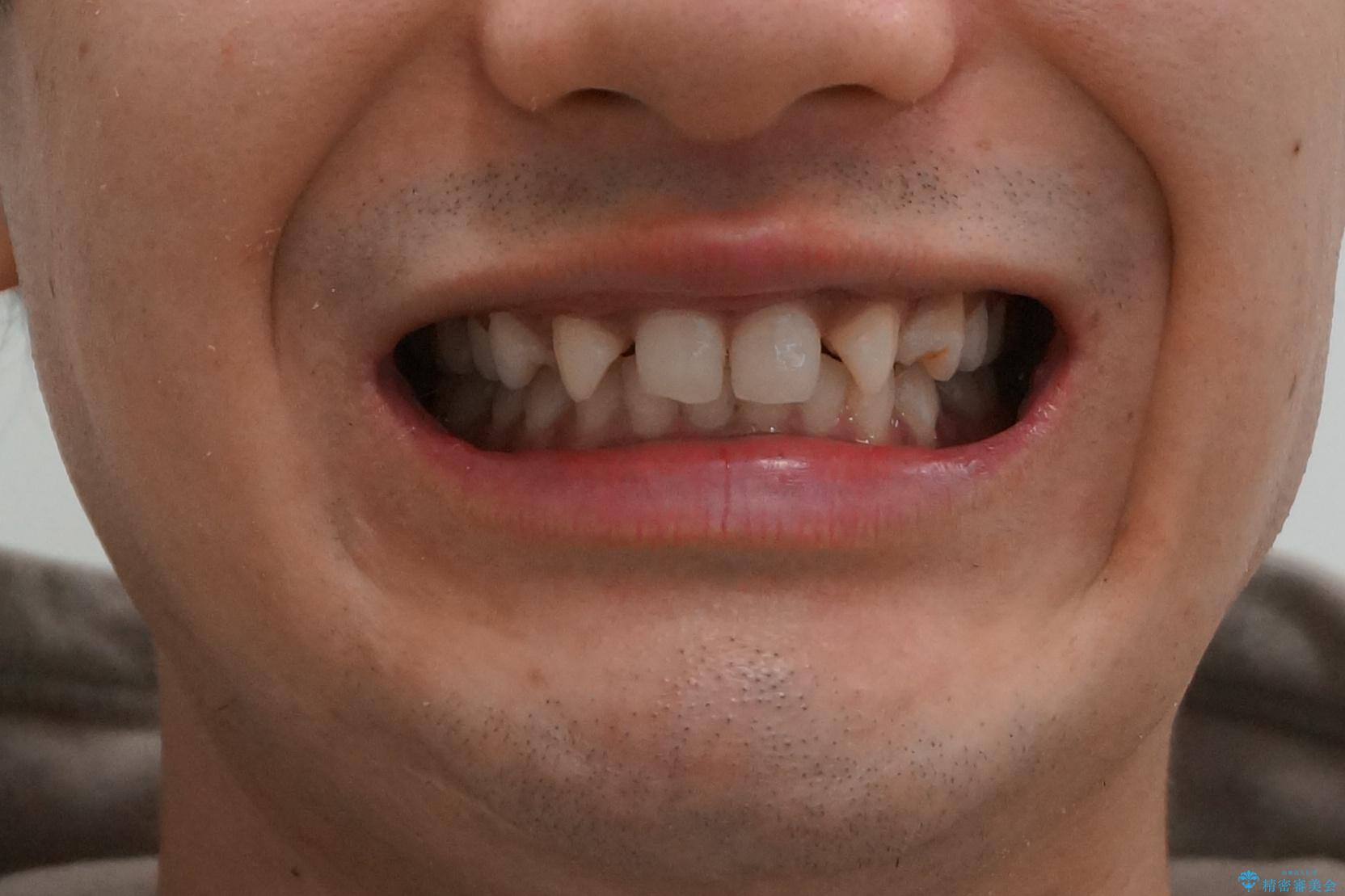 前歯のすきま　生まれつき歯が少ないのを治療の治療前（顔貌）