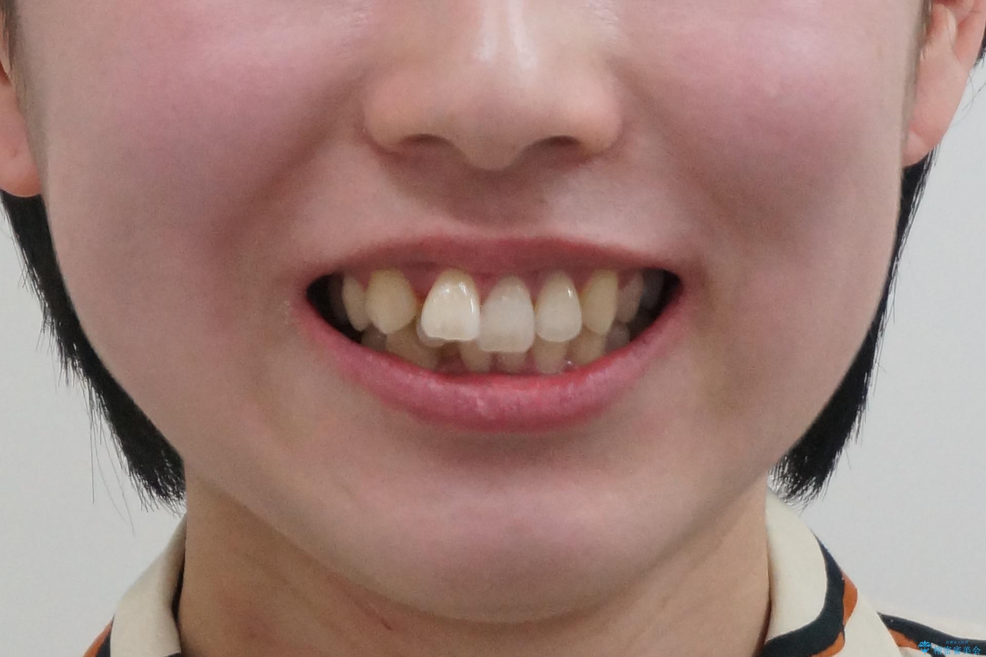 やや難ケース 上の歯を抜かずに歯列を後ろに下げて治療 4本ではなく下1本のみの抜歯できれいにの治療前(顔貌)