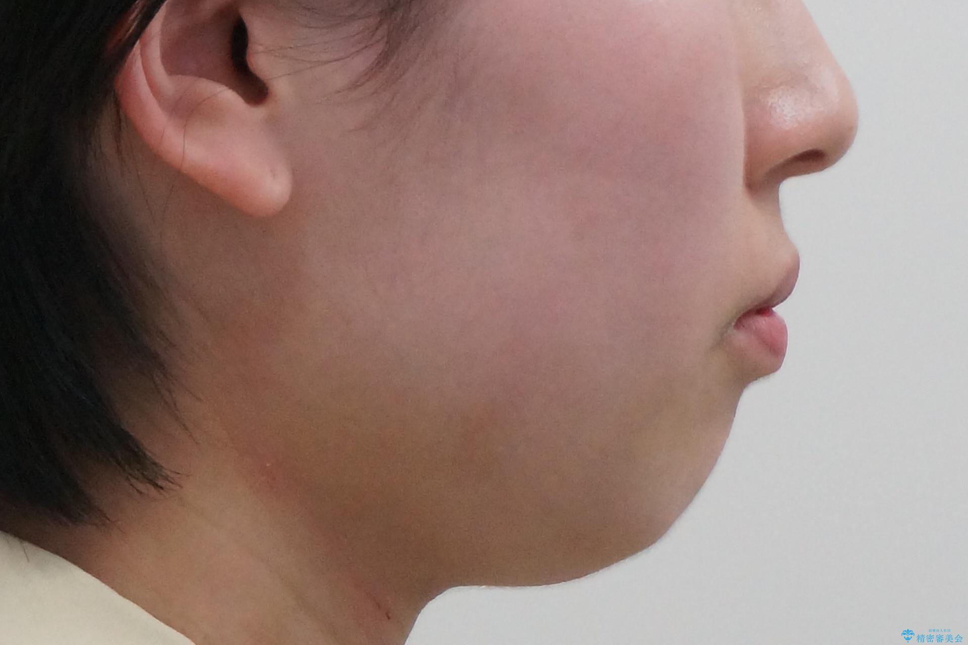 やや難ケース 上の歯を抜かずに歯列を後ろに下げて治療 4本ではなく下1本のみの抜歯できれいにの治療前(顔貌)