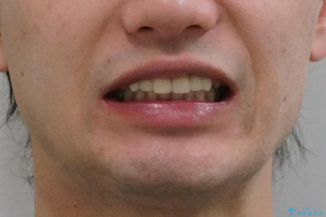 前歯のすきま　生まれつき歯が少ないのを治療の治療後（顔貌）