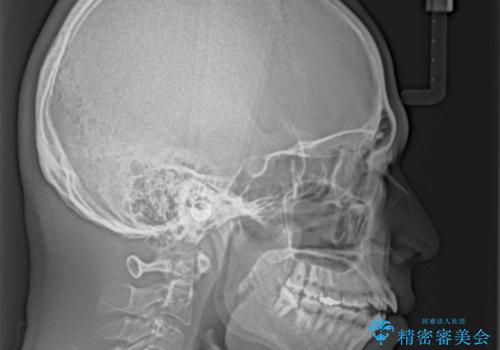 開咬とデコボコを整える インビザライン矯正治療の治療前