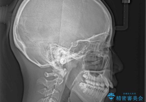 上顎骨幅が狭い 急速拡大装置を併用した抜歯矯正の治療前