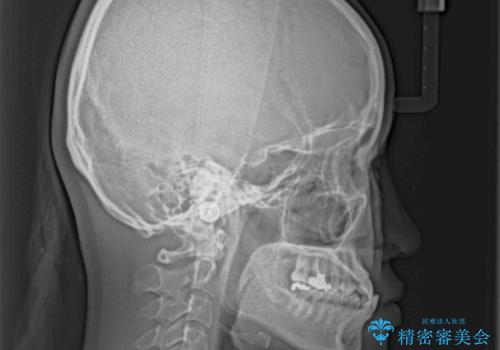 反対咬合を治したい ワイヤー装置で一気に咬み合わせを改善の治療前