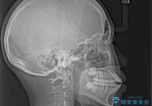 舌突出癖で出っ歯と開咬に 舌のトレーニングを行いながら抜歯矯正 の治療前