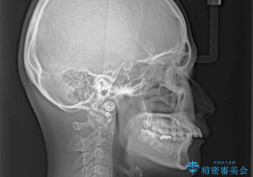 【モニター】出っ歯と八重歯 抜歯矯正でスッキリとした口元にの治療前
