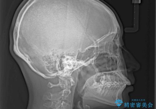飛び出した前歯を引っ込めたい ワイヤー装置での抜歯矯正の治療前