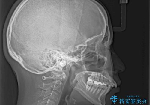 気になる出っ歯を治したい　抜歯矯正でスッキリした横顔にの治療前