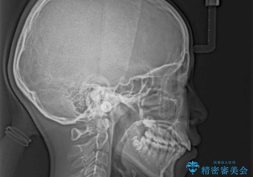 気がつくと唇があいてしまう ワイヤー装置での抜歯矯正の治療前