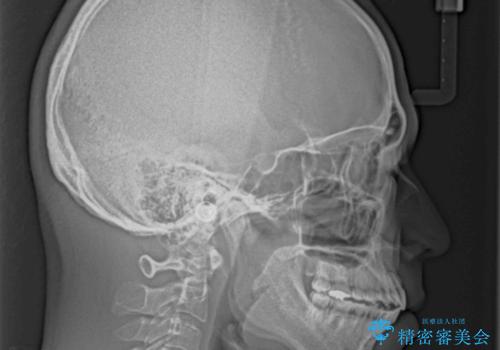 開咬とデコボコを整える インビザライン矯正治療の治療後