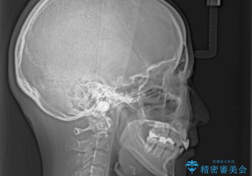 気になる出っ歯を治したい　抜歯矯正でスッキリした横顔にの治療後