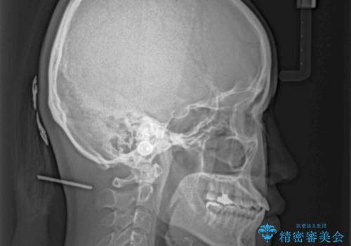 反対咬合を治したい ワイヤー装置で一気に咬み合わせを改善の治療後