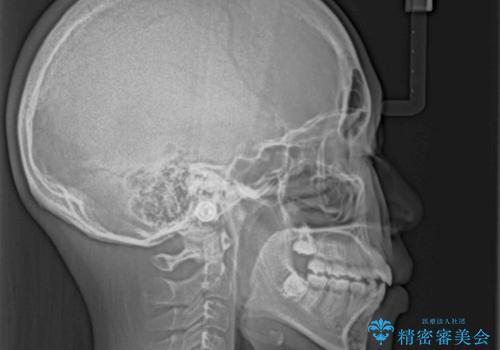 舌突出癖で出っ歯と開咬に 舌のトレーニングを行いながら抜歯矯正 の治療後