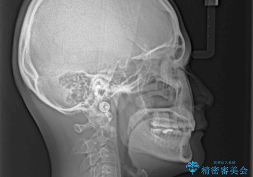 【モニター】出っ歯と八重歯 抜歯矯正でスッキリとした口元にの治療後