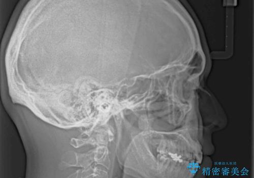 しゃくれて口が閉じられない ワイヤー装置での抜歯矯正の治療後