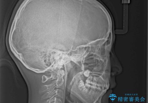 気がつくと唇があいてしまう ワイヤー装置での抜歯矯正の治療後