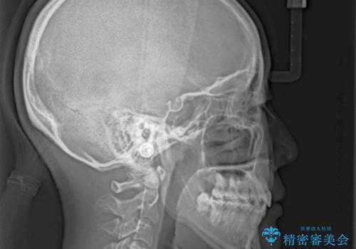 上顎骨幅が狭い 急速拡大装置を併用した抜歯矯正の治療後