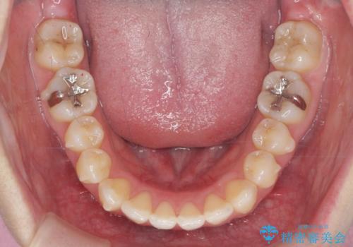 不安定な噛み合わせを改善 マウスピース矯正治療の治療中