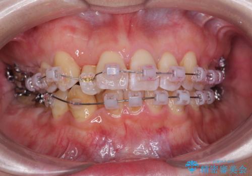 やや難ケース 上の歯を抜かずに歯列を後ろに下げて治療 4本ではなく下1本のみの抜歯できれいにの治療中