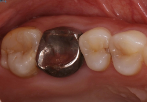 歯の間に食べ物がよく挟まるのを治したいの症例 治療前