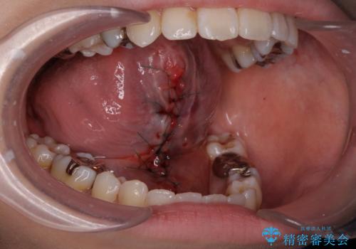 舌が動かしにくいから舌小帯を切りたいの治療中