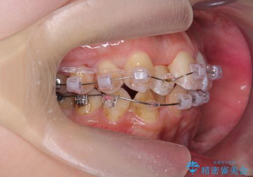 やや難ケース 上の歯を抜かずに歯列を後ろに下げて治療 4本ではなく下1本のみの抜歯できれいにの治療中