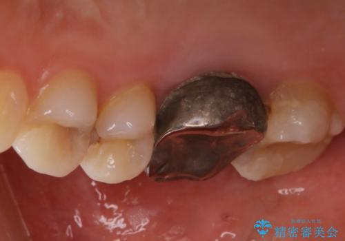 歯の間に食べ物がよく挟まるのを治したいの治療前