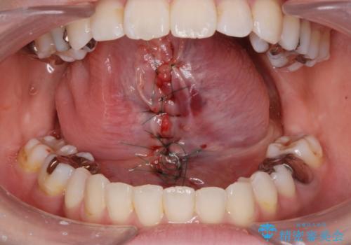 舌が動かしにくいから舌小帯を切りたいの治療中