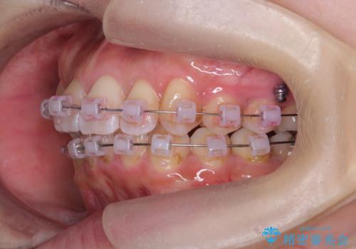 やや難ケース　上の歯を抜かずに歯列を後ろに下げて治療　4本ではなく下1本のみの抜歯できれいにの治療中
