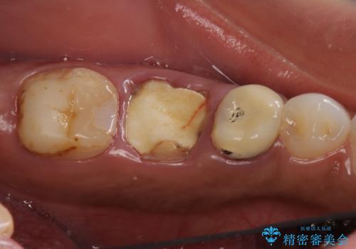 奥歯の高さがない 20代で入れ歯もインプラントも難しい ブリッジで歯を残す治療の治療前