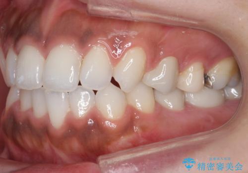 奥歯の高さがない　20代で入れ歯もインプラントも難しい　ブリッジで歯を残す治療の治療後