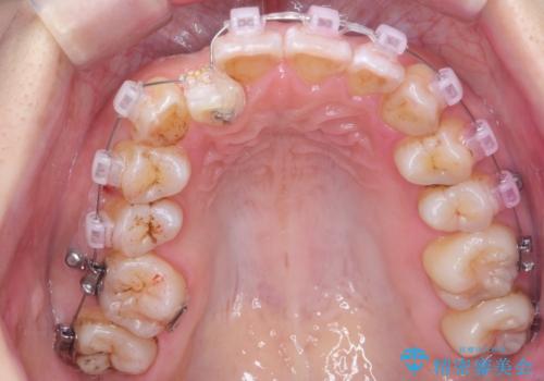 やや難ケース 上の歯を抜かずに歯列を後ろに下げて治療 4本ではなく下1本のみの抜歯できれいにの治療中