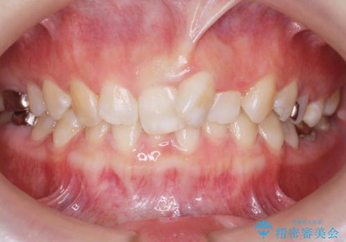 ねじれた前歯を改善するマウスピース矯正の症例 治療前