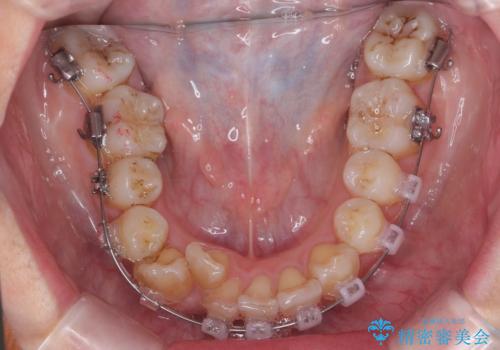 やや難ケース　上の歯を抜かずに歯列を後ろに下げて治療　4本ではなく下1本のみの抜歯できれいにの治療中