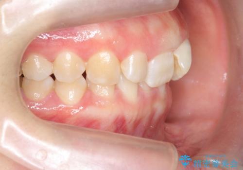 ねじれた前歯を改善するマウスピース矯正の治療前